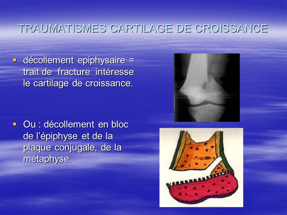 TRAUMATISMES CARTILAGE CROISSANCE ppt video online t l charger